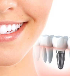 Dental Implants replace single or multiple teeth