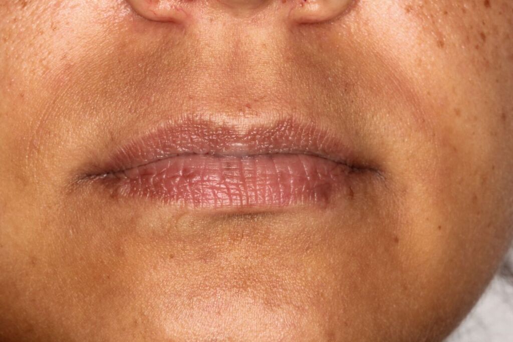 Lip filler example before