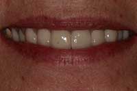 Dental Implant Example After