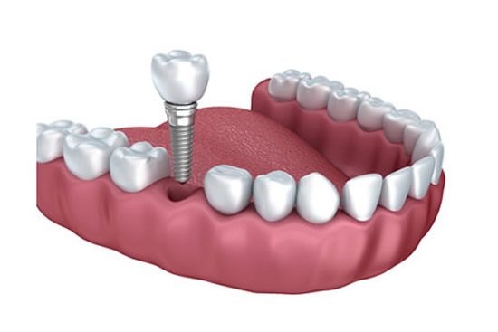 Single Dental Implant