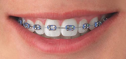 Metal braces